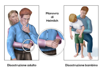 Heimlich Adulto Bambino