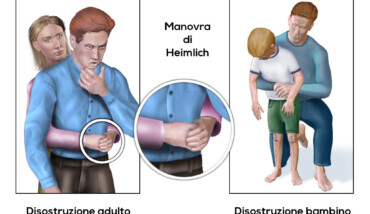 Heimlich Adulto Bambino