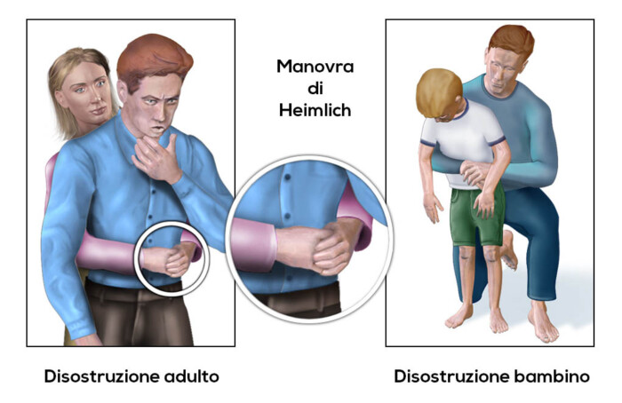 Heimlich Adulto Bambino