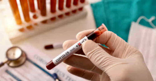 Covid 19 Provetta Sangue Test Sierologici 2 2