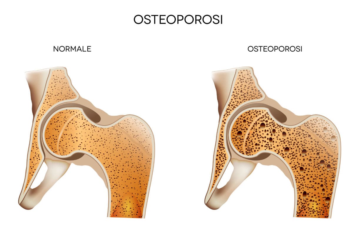 Farmacia Bassette Osteoporosi